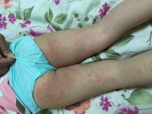 龟头有红色疹子图片,成因、症状及防治策略