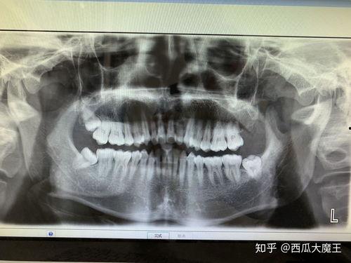 拔牙全过程视频,拔牙手术的每一个关键步骤