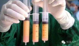 抽出来10斤脂肪的图片,10斤脂肪抽离，见证健康美丽新篇章