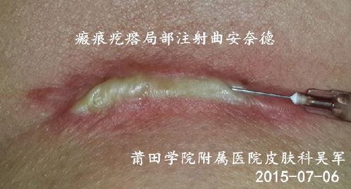 牙缝疙瘩图片