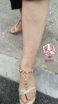 被跳蚤咬的图片,细看皮肤上的“小刺客”痕迹