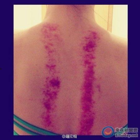 刮痧的图片大全集,全方位解析刮痧图片大全集