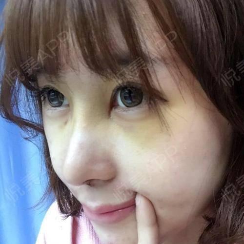 线掉鼻子图片大全