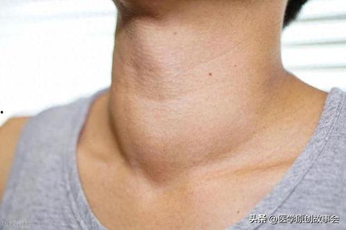 甲状腺结节肿大图片,图解与诊断要点