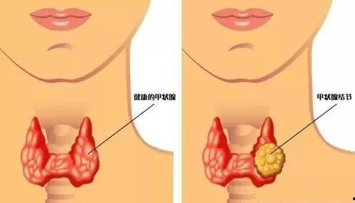 甲状腺结节肿大图片,图解与诊断要点
