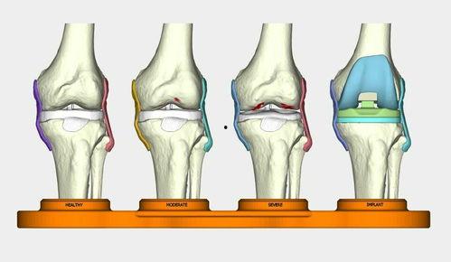 膝关节置换图片,术前术后护理与康复要点