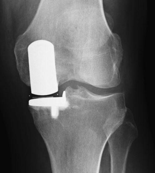 膝关节置换图片,术前术后护理与康复要点