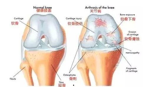 膝关节置换图片,术前术后护理与康复要点