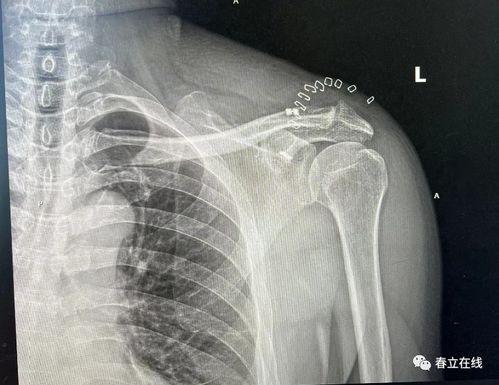 肩锁关节脱位图片,图解与概述