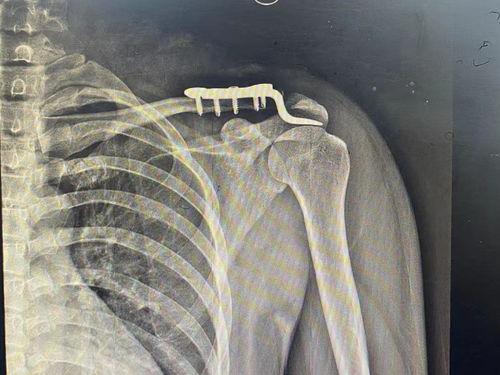 肩锁关节脱位图片,图解与概述