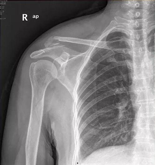 肩锁关节脱位图片,图解与概述