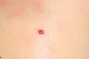 红痣图片,揭秘其成因与影响