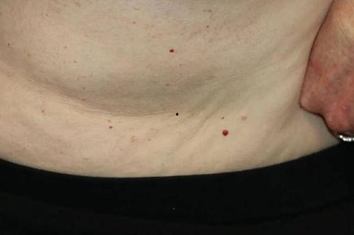 红痣图片,揭秘其成因与影响