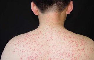 身上长湿疹的图片