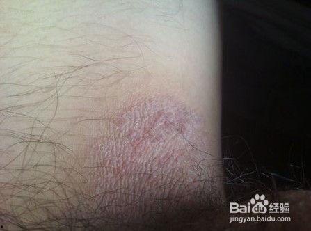 身上长湿疹的图片