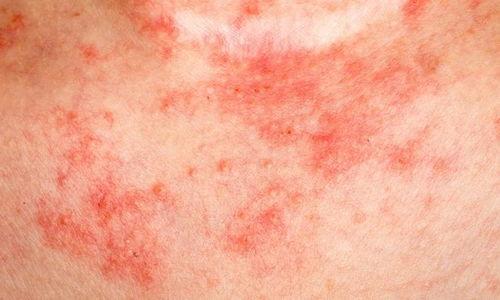 身上长湿疹的图片