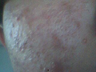 全世界最大的脓包视频,一场视觉震撼的医学奇观