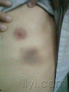 皮肤瘀斑图片,皮肤瘀斑成因及护理要点解析