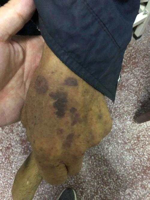 皮肤瘀斑图片,皮肤瘀斑成因及护理要点解析