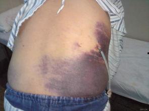 皮肤瘀斑图片,皮肤瘀斑成因及护理要点解析