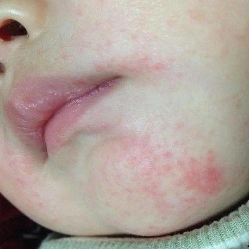 宝宝口水疹图片,症状图解与护理要点