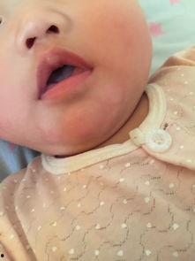 宝宝口水疹图片,症状图解与护理要点