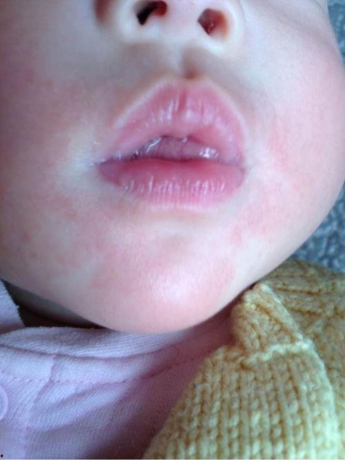 宝宝口水疹图片,症状图解与护理要点